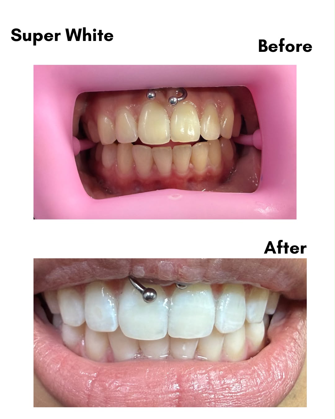Super White resultaat — before en after