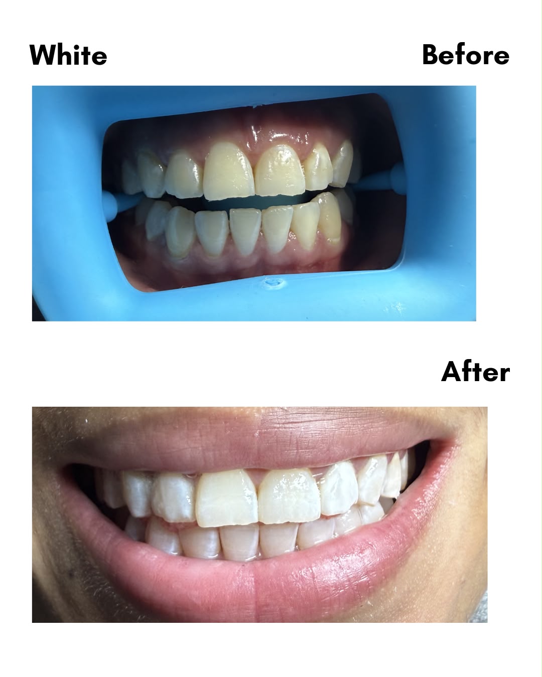 White resultaat — before en after